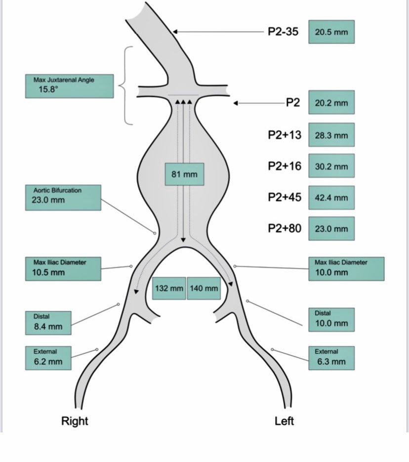 OckeReis's tweet photo. #AAA #Aneurisma Procure um especialista.Publicação autorizada .
#Challengecase
#ShortNeck
#ShortAorticlenght
#LeftRenalArteryprotection
#vascularsurgery
#endovascularsurgery https://t.co/CyMI9dfYvo