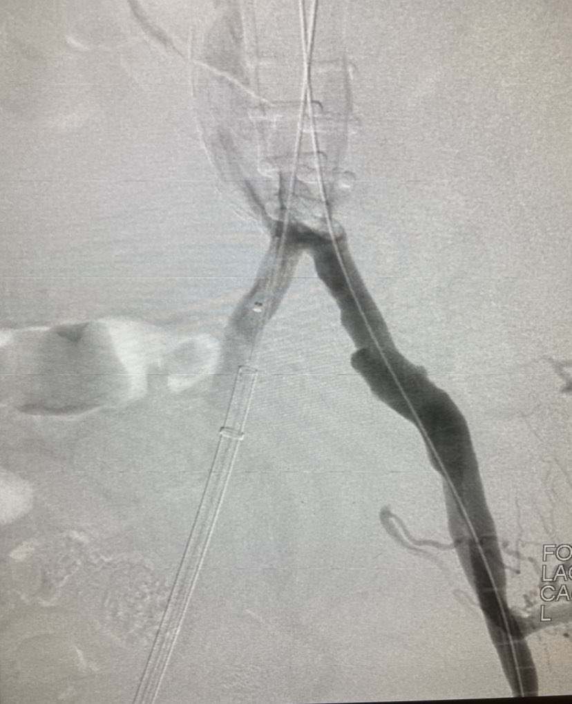 OckeReis's tweet photo. #AAA #Aneurisma Procure um especialista.Publicação autorizada .
#Challengecase
#ShortNeck
#ShortAorticlenght
#LeftRenalArteryprotection
#vascularsurgery
#endovascularsurgery https://t.co/CyMI9dfYvo