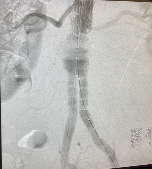OckeReis's tweet photo. #AAA #Aneurisma Procure um especialista.Publicação autorizada .
#Challengecase
#ShortNeck
#ShortAorticlenght
#LeftRenalArteryprotection
#vascularsurgery
#endovascularsurgery https://t.co/CyMI9dfYvo