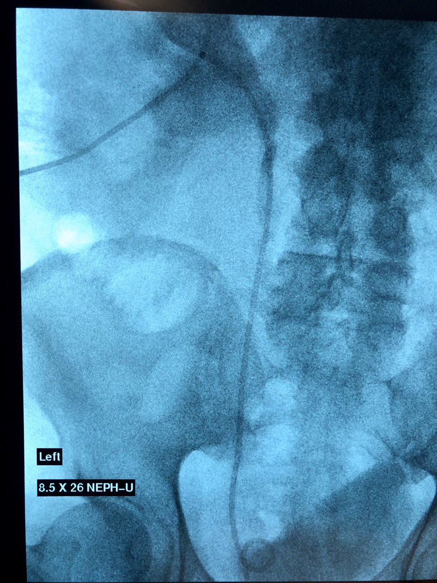 Large renal calculus, pt comes in w/worsening pain &amp; renal function, image guided percutaneous nephroureterostomy placed, home same day &amp; stones removed by urology as outpatient. #irad #withoutascalpel #collaborate #KidneyDisease <a href="/Guthrie_Clinic/">Guthrie Clinic</a> <a href="/guthrie_ir/">GuthrieIR</a>