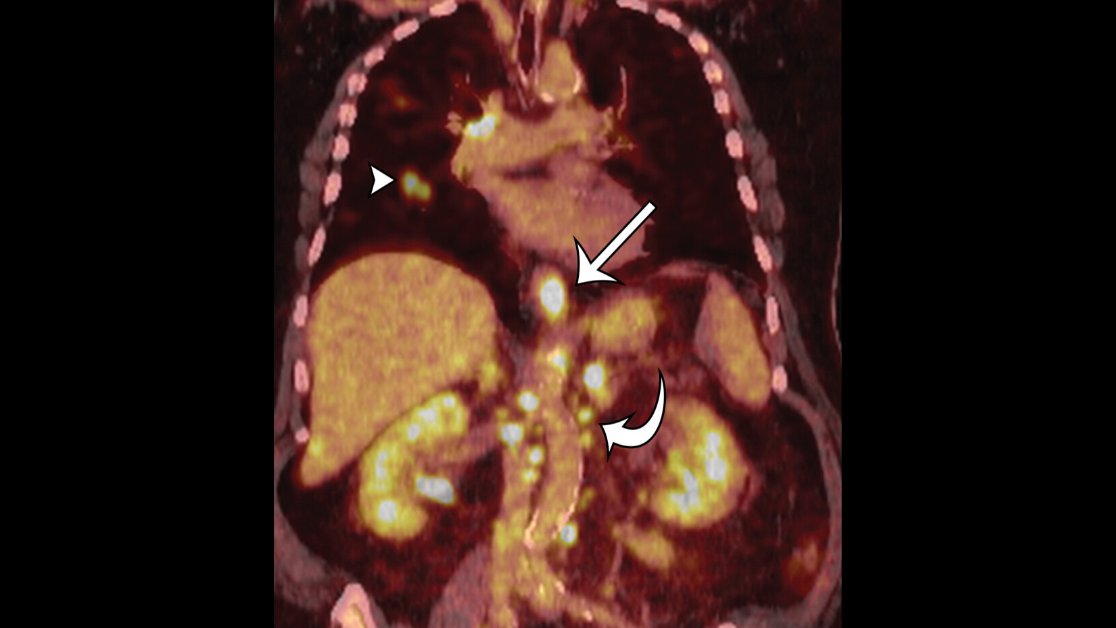 Given the rising incidence of #GERD, understand the crucial role of multimodality imaging in detecting and evaluating its complications, namely reflux esophagitis, peptic stricture, Barrett esophagus, and esophageal adenocarcinoma. bit.ly/2sTiWct #AbRad #RadCME