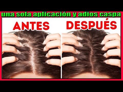 Elimina La Caspa Para Siempre Con Una Sola Aplicación De Estos Remedios youtu.be/QlW0O__FL8o vía <a href="/YouTube/">YouTube</a>