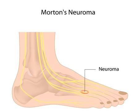 A #neuroma is a benign growth of nerve tissue frequently found between the third and fourth #toes. It brings on #pain, a burning sensation, #tingling, or #numbness between the toes and in the ball of the #foot. Watch our video to learn more: ow.ly/VsEq50xT1kz