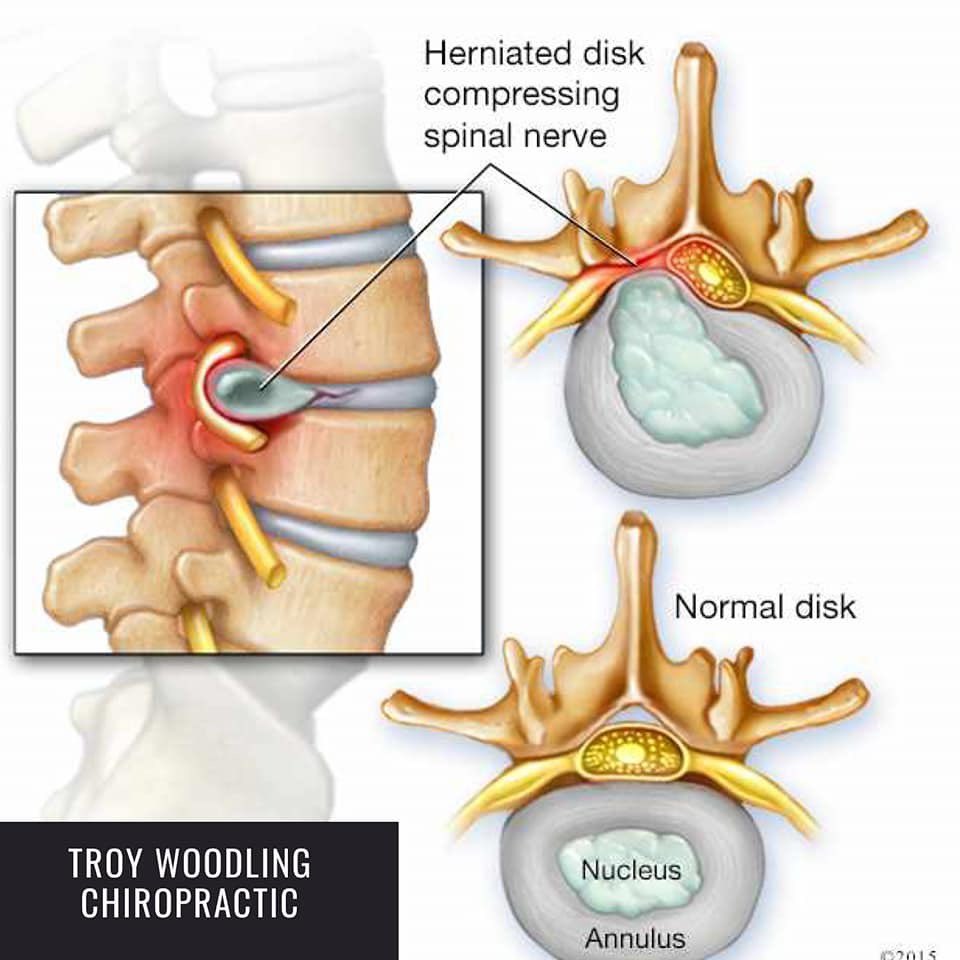 TroyWoodling's tweet photo. There is a countless amount of people who suffer from herniated discs every day. Our decompression service can release you from this pain and help you to feel fast relief! It works by slowly stretching your spine and therefore releasing the tension between the discs! https://t.co/NO9BXea0mY