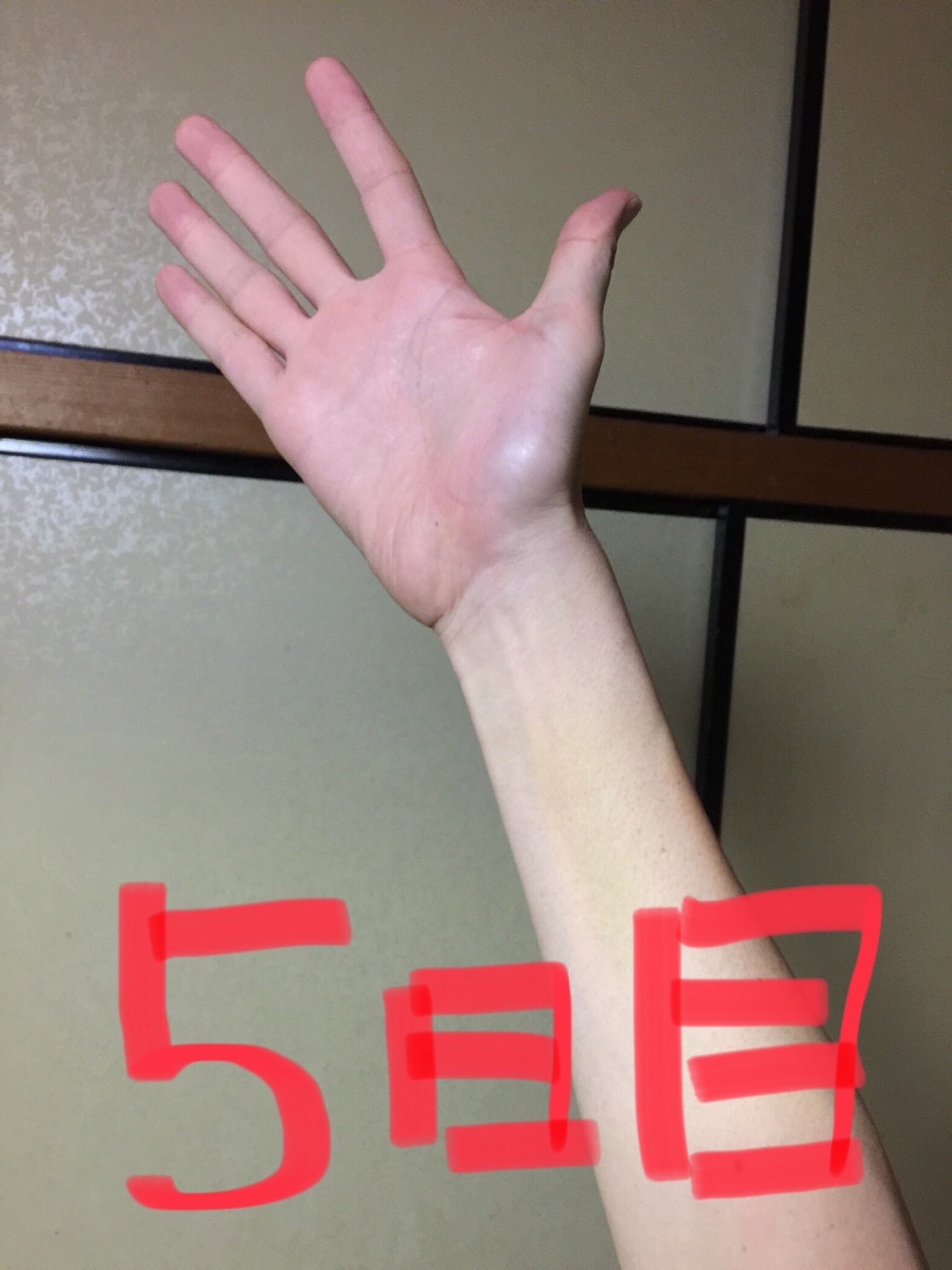 Uzivatel 吉田 侑弥 Na Twitteru リハビリ5日目 身体が温まっていると指先が肩につくようになる すごい嬉しい 反りも慣らして慣らしての継続 おててのしわとしわをあわせて 手首ぺこり経過 昨日より数センチぺこりできてるよね 手が赤いのは温め Uzivatel 吉田 侑弥 Na Twitteru リハビリ5日目 身体が温まっていると指先が肩につくようになる すごい嬉しい 反りも慣らして慣らしての継続 おててのしわとしわをあわせて 手首ぺこり経過 昨日より数センチぺこりできてるよね 手が赤いのは温め