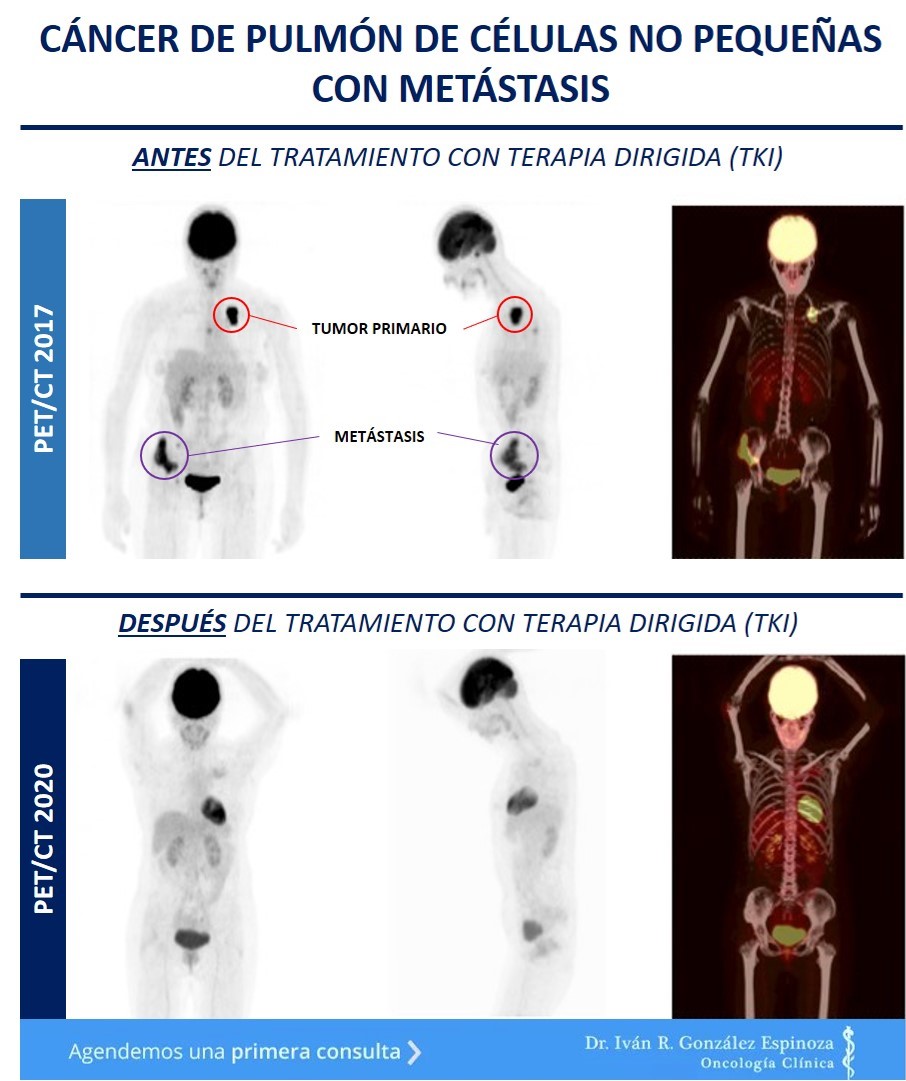 Les comparto imágenes de #PET/TC de un paciente con #CáncerDePulmón de células no pequeñas con METs óseas y ganglionares, en las que se evidencia los resultados obtenidos antes/después de su Tx. con un #TKI (#Osimertinib) a ~3 años de haber depositado su confianza en nosotros.