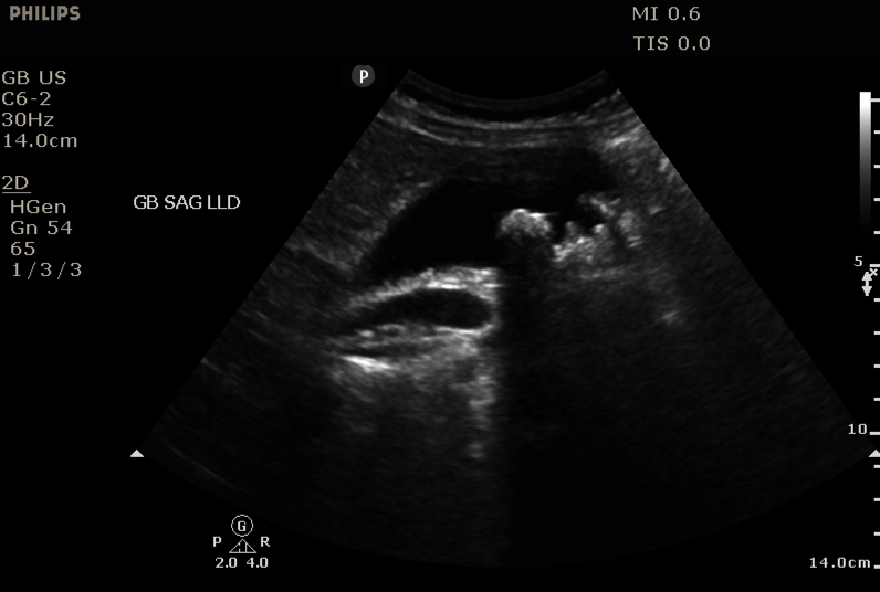 RJonesSonoEM's tweet photo. Male with RUQ abdominal pain for 2 days.  GB sag/trv below.  Neg Sonographic Murphy's. GB TRV meas- 4.84 cm trv.  Labs show elevated WBC, AST/ALT, Alk Phos, T Bili. Additional images in thread.  #POCUS #IMPOCUS #FOAMed #FOAMus #MedEd #ultrasound @MetroHealth_EM @USIGcleveland https://t.co/ZHKmVSqQTP