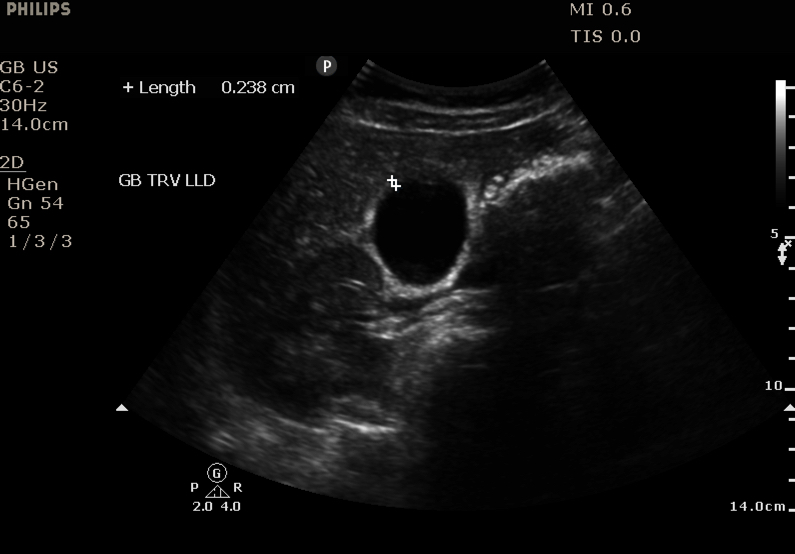 RJonesSonoEM's tweet photo. Male with RUQ abdominal pain for 2 days.  GB sag/trv below.  Neg Sonographic Murphy's. GB TRV meas- 4.84 cm trv.  Labs show elevated WBC, AST/ALT, Alk Phos, T Bili. Additional images in thread.  #POCUS #IMPOCUS #FOAMed #FOAMus #MedEd #ultrasound @MetroHealth_EM @USIGcleveland https://t.co/ZHKmVSqQTP