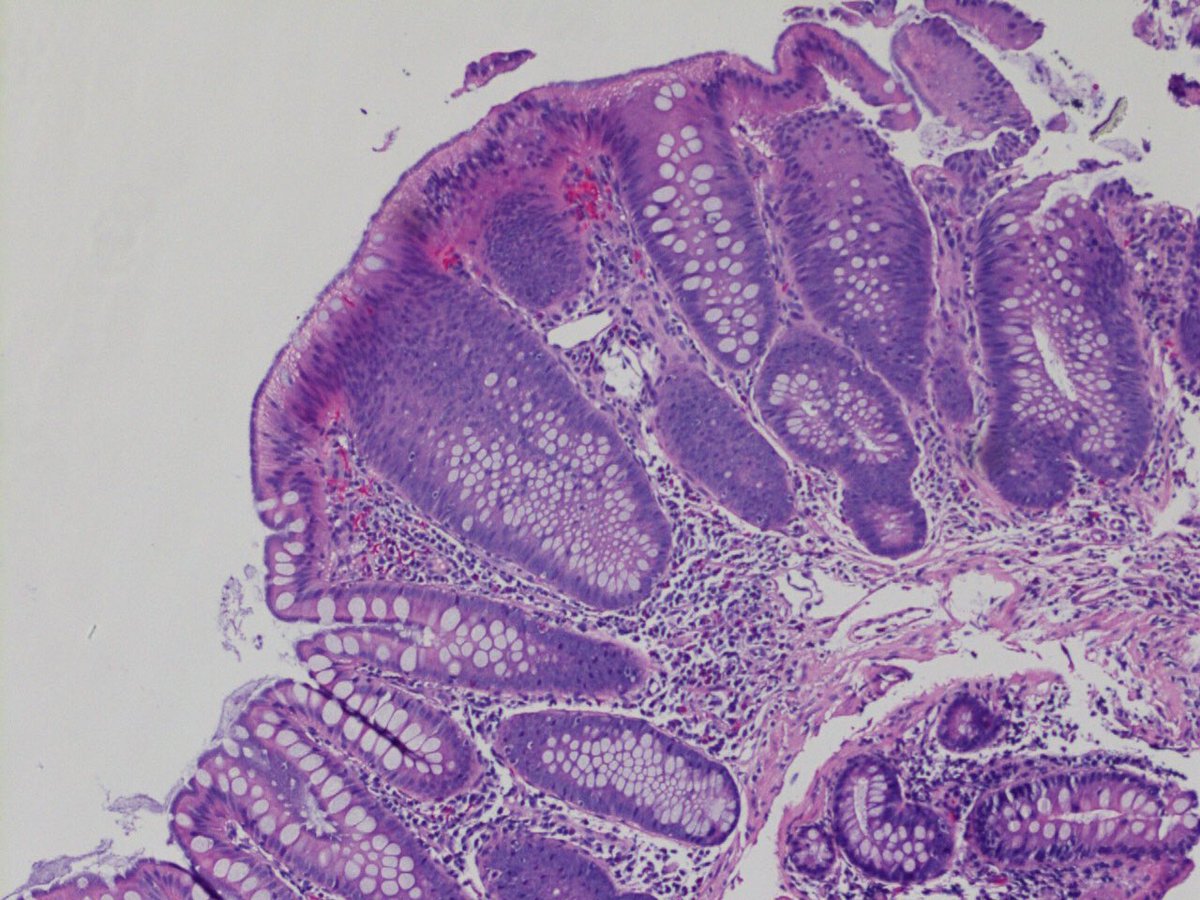 UTSW_GIpath's tweet image. Twofer in a colon polyp ⁦@SuntreaHammer⁩ ⁦@Purvago⁩ ⁦@ALBoothMD⁩ ⁦@CArnold_GI⁩ ⁦@NU_GIpath⁩ #gipath