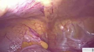 AAGL's tweet photo. Deep infiltrating #endometriosis can pose challenges for #surgeons and #patients. A full length surgery can be found on #SurgeryU showing how to tackle disease involving the rectum, sacral roots, vagina, and parametrium. #SurgeryNew
https://t.co/qaxUcborVl https://t.co/tapjUWUqmY