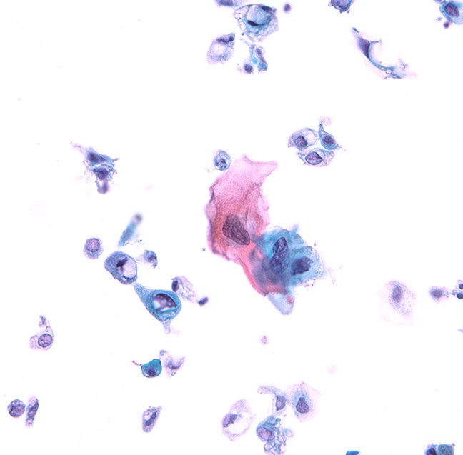 dkurtycz's tweet photo. @ParisSystem2 squamous cell carcinoma of bladder https://t.co/x3zYDseZ8a