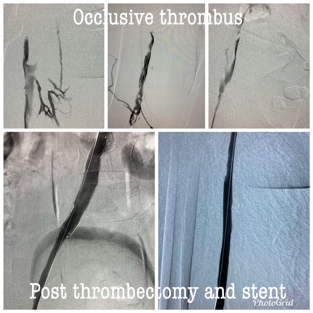 Acute, very symptomatic iliofemoral DVT in a young patient related to May-Thurner compression.  Treated with same session ClotTriever mechanical thrombectomy,  IVUS -> Iliac stent.  Swelling and pain improving by 12 hours post and discharged at 36hours post. #iRad