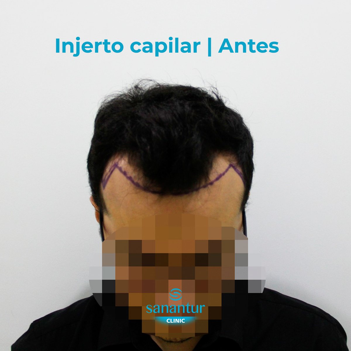 Sanantur_'s tweet photo. ¡Cambio radical! 

Después de hacerle el diagnóstico capilar en la clínica Sanantur este paciente viajó a Turquía para hacerse el injerto capilar. Así son los resultados un año después 👏 https://t.co/d7R2kCRsUy