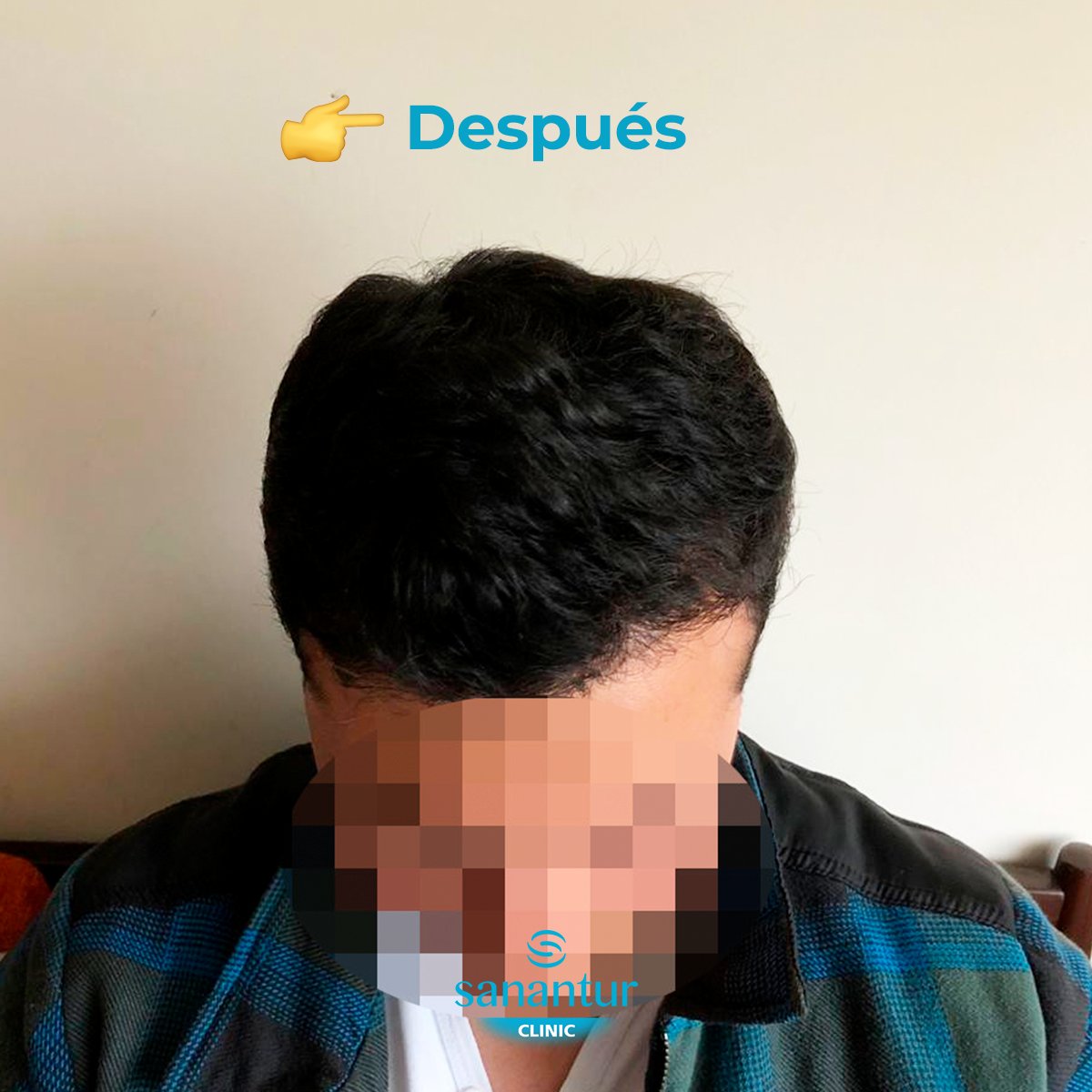 Sanantur_'s tweet photo. ¡Cambio radical! 

Después de hacerle el diagnóstico capilar en la clínica Sanantur este paciente viajó a Turquía para hacerse el injerto capilar. Así son los resultados un año después 👏 https://t.co/d7R2kCRsUy