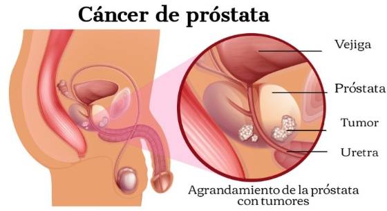 cronología del cáncer de próstata