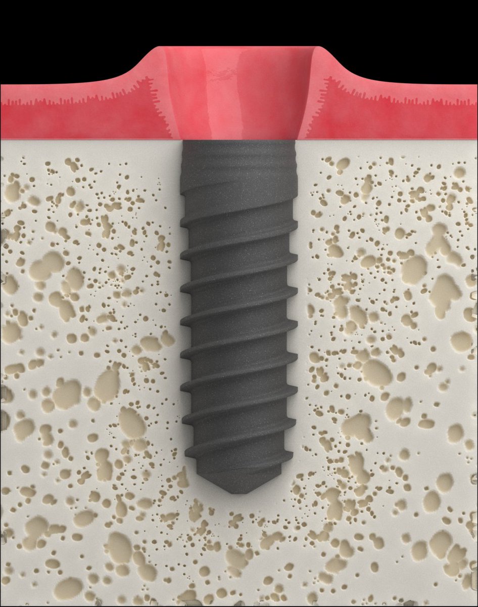 DentotalProtect's tweet image. Klocner® Implant Vega®
✅Standarde de inovatie, siguranta, simplitate si estetica
✅Conexiune interna con-hexagon
✅Principiul "platform switch" 

dentotal.ro/implanturi/veg…

📱0725 555 243
📧andreea.chiriac@dentotal.ro

#klockner #dentotal #implantology #implanto #vegaimplant