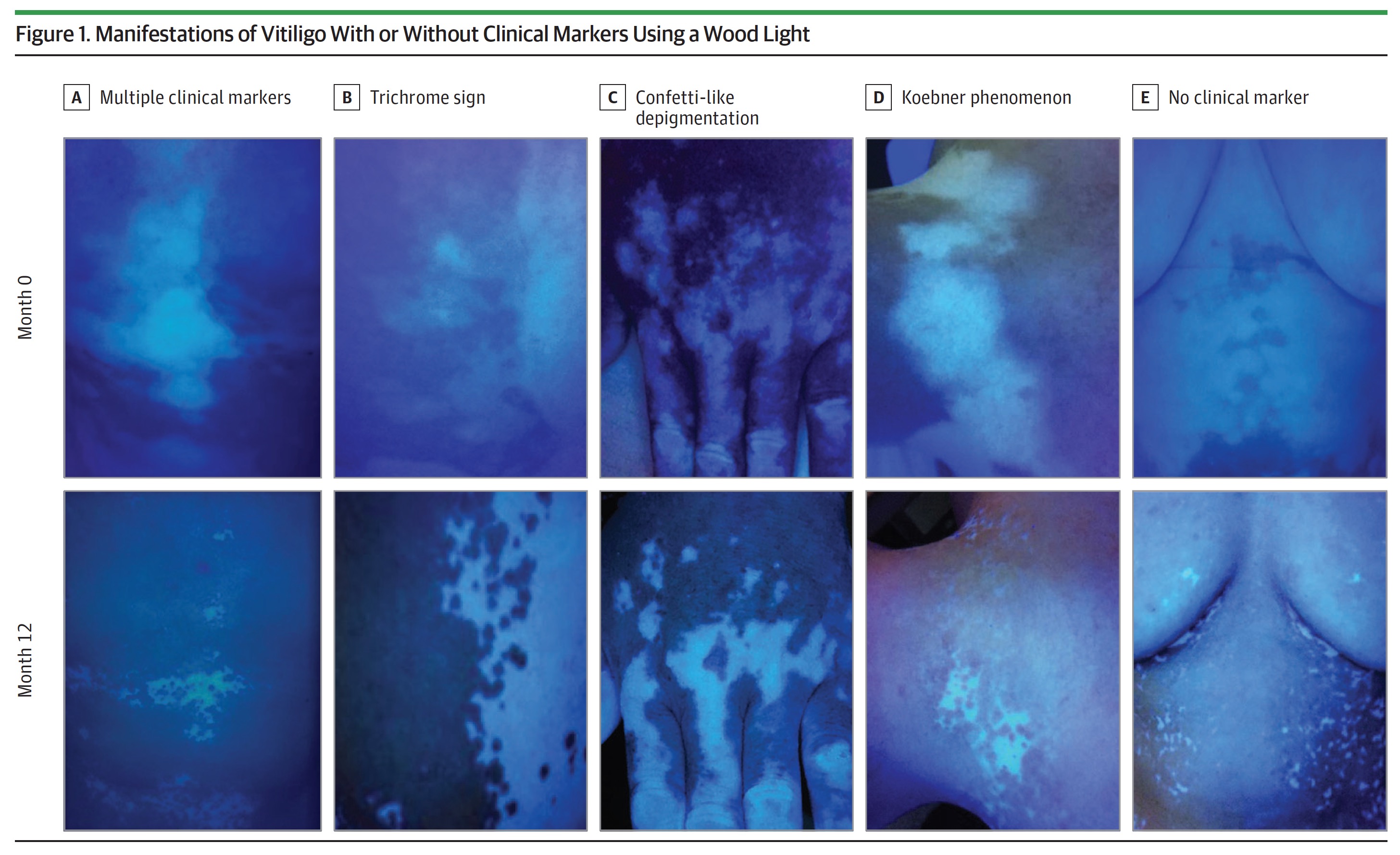 Monica Ramos on X: La luz de wood gran aliado en nuestra práctica clinica  #luzdewood #vitiligo / X