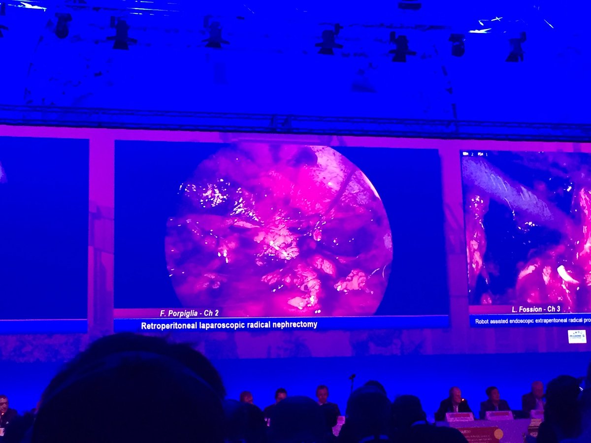 tom_silvestri's tweet photo. @eauesut @leipzig excellent demonstration of a retroperitoneal laparoscopic nephrectomy by Prof @PorpigliaF. Natural approach with a duplication of open surgery principles!! We should do it as our daily bread!! Inspiring!!! @SIU_Italia @Uroweb @BassanoUrology https://t.co/VPz78cJ3dT