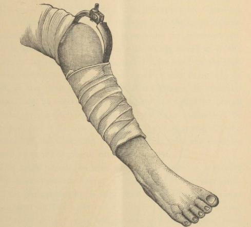 5.Gramsci described being hanged up for hours by a harness from a beam on the ceiling on doctors' orders to straighten his curved spine, which matched contemporaneous medical treatments of continuous traction & plasters shown here.../ #DisHist  #histmed