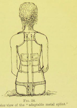 5.Gramsci described being hanged up for hours by a harness from a beam on the ceiling on doctors' orders to straighten his curved spine, which matched contemporaneous medical treatments of continuous traction & plasters shown here.../ #DisHist  #histmed
