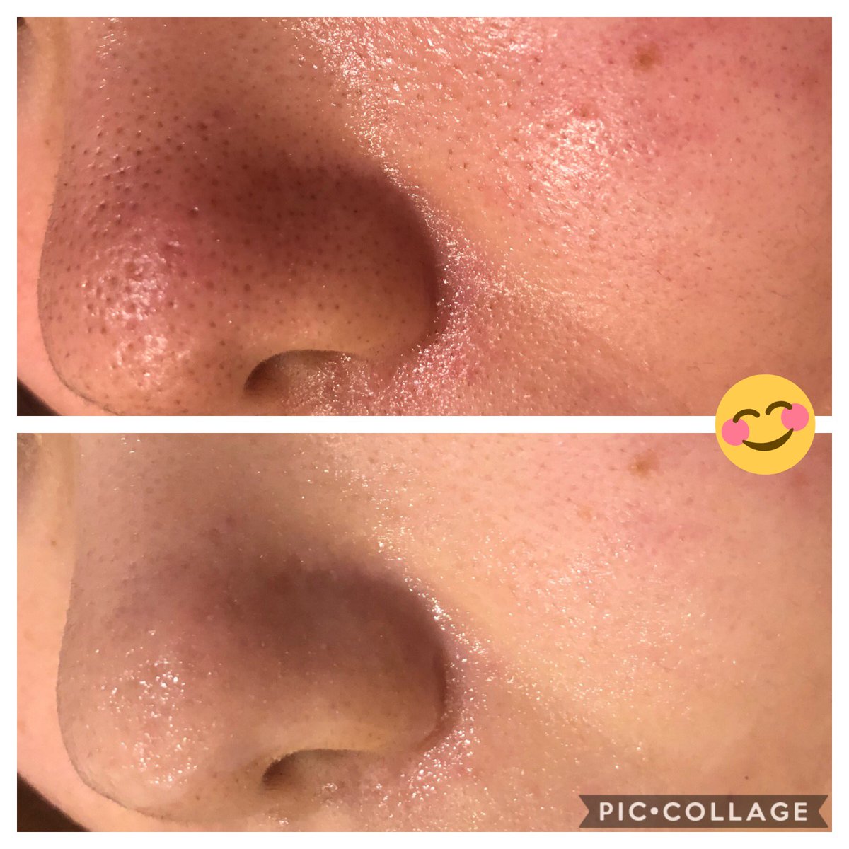 エステサロン Ensor Clair 代表 野口 真央 たまにはtwitterでも 症例写真を ニキビもクレーター も毛穴も しっかり改善できます 赤みも 皮膚科医よりすごい施術だと 自負してる笑