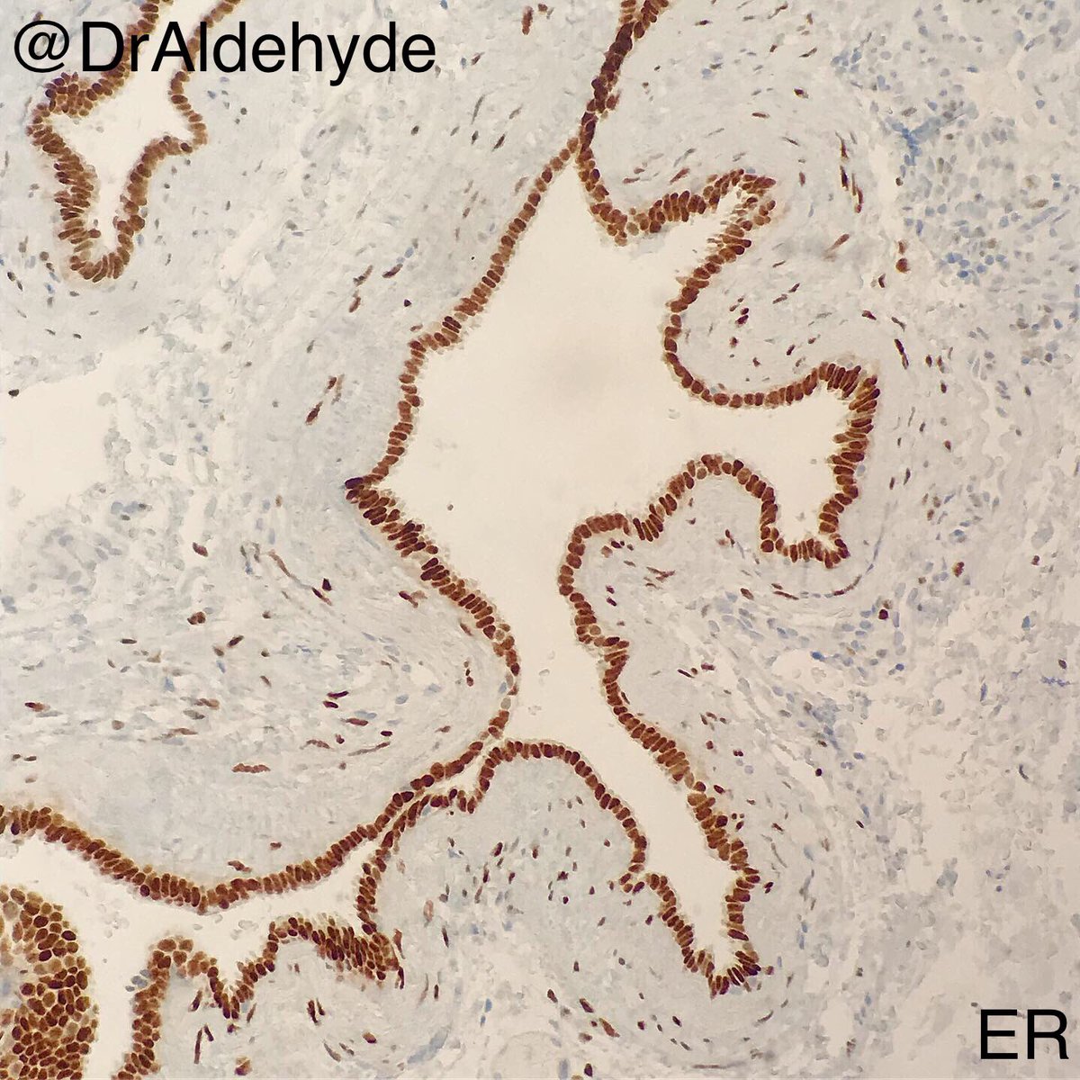 DrAldehyde's tweet image. #ThoracicPath special. 😆🔬

Does it look like a portion of fallopian tube? What if it’s cystic and found in the posterior mediatinum? 

Posterior mediastinal Mullerian cyst = Mediastinal cyst with Mullerian differentiation = Hattori cyst 

#SurgPath #PulmPath