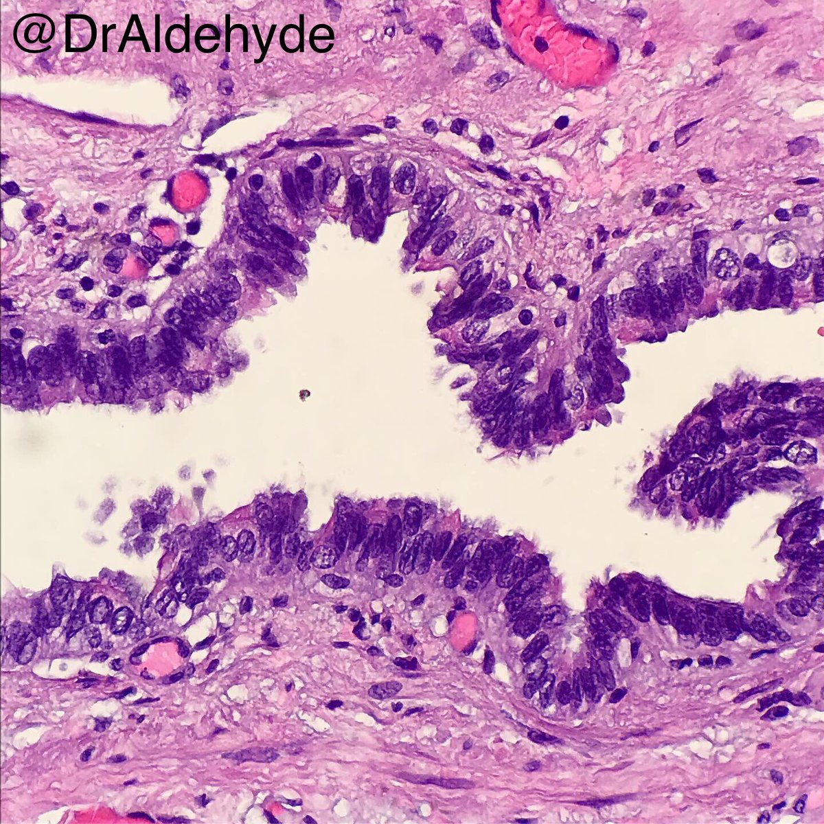 DrAldehyde's tweet image. #ThoracicPath special. 😆🔬

Does it look like a portion of fallopian tube? What if it’s cystic and found in the posterior mediatinum? 

Posterior mediastinal Mullerian cyst = Mediastinal cyst with Mullerian differentiation = Hattori cyst 

#SurgPath #PulmPath