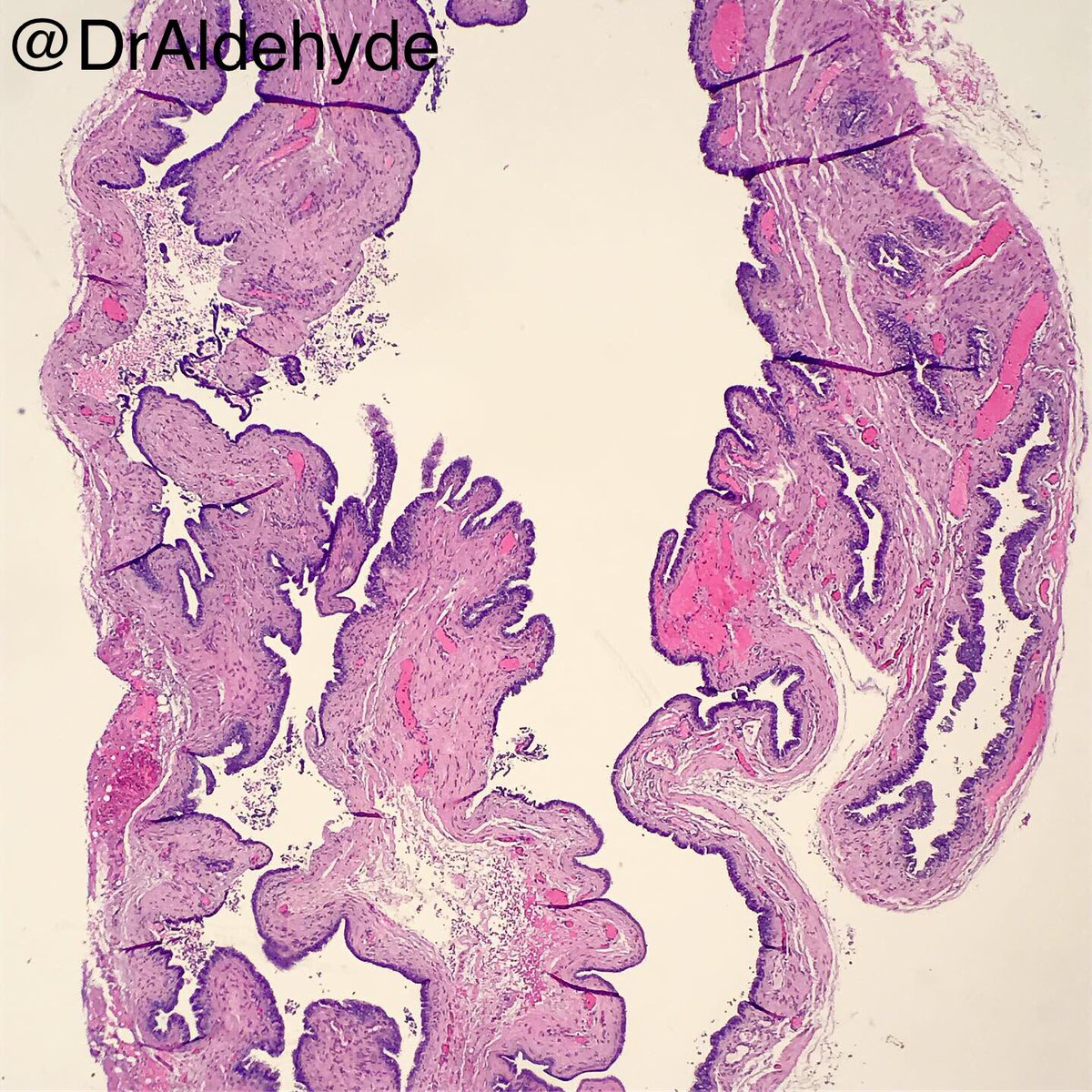 DrAldehyde's tweet image. #ThoracicPath special. 😆🔬

Does it look like a portion of fallopian tube? What if it’s cystic and found in the posterior mediatinum? 

Posterior mediastinal Mullerian cyst = Mediastinal cyst with Mullerian differentiation = Hattori cyst 

#SurgPath #PulmPath