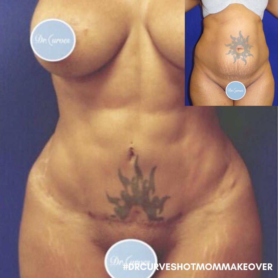 drcurves's tweet photo. #tummytuck ✔️ #abetching ✔️ #liposuction ✔️ #breastaugmentation ✔️ #breastlift ✔️#hotmommakeover ✔️⁣
⁣
Would you like to check these items off your list and receive the #drcurveshotmommakeover?! https://t.co/Tr7pMwEdyf
