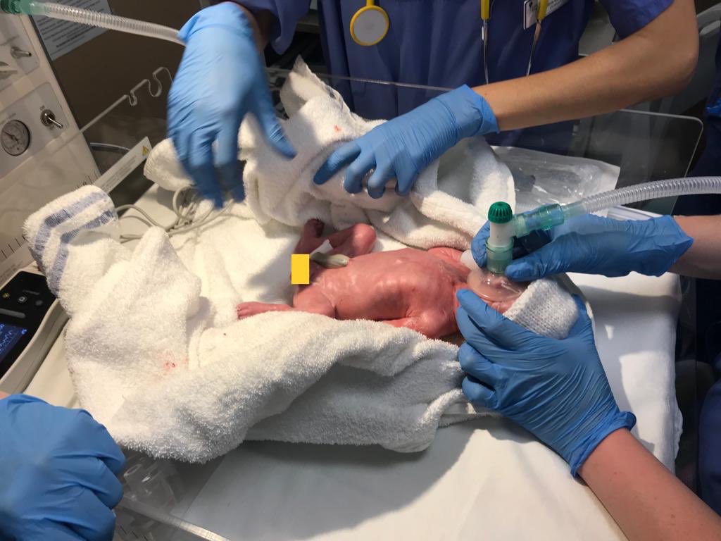 CarolineVerdon's tweet photo. @darren_e_goode @elvie 20 weeks later we’re still going and he’s gone from 3lbs to this little heavyweight! #elvie #expressing #exclusivelyexpressing https://t.co/UaoKATfG5P