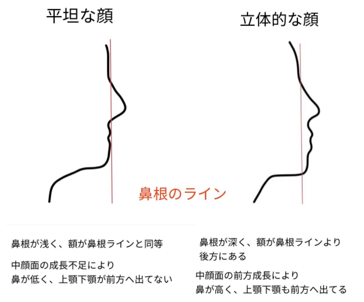 ぱにたん 例外があるかもだけど 平坦 鼻根が浅く 額が鼻根ラインと同等 中顔面の成長不足により鼻が低く 上下顎が前方へ出てない 立体的 鼻根が深く 額が鼻根ラインより後方にある 中顔面の前方成長により鼻が高く 上下顎も前方へ出てる 平坦だと ぱにたん 例外があるかもだけど 平坦 鼻根が浅く 額が鼻根ラインと同等 中顔面の成長不足により鼻が低く 上下顎が前方へ出てない 立体的 鼻根が深く 額が鼻根ラインより後方にある 中顔面の前方成長により鼻が高く 上下顎も前方へ出てる 平坦だと