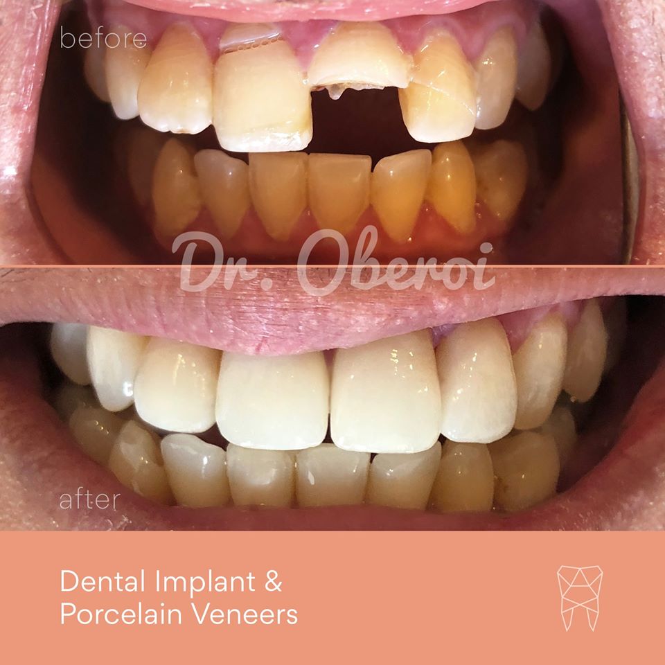 Paramount Dental On Twitter Smile Our Patient Came To Us Following An Accident In Their Shed While Using Tools Dr Amrinder Oberoi Was Able To Restore His Smile With A Single Tooth