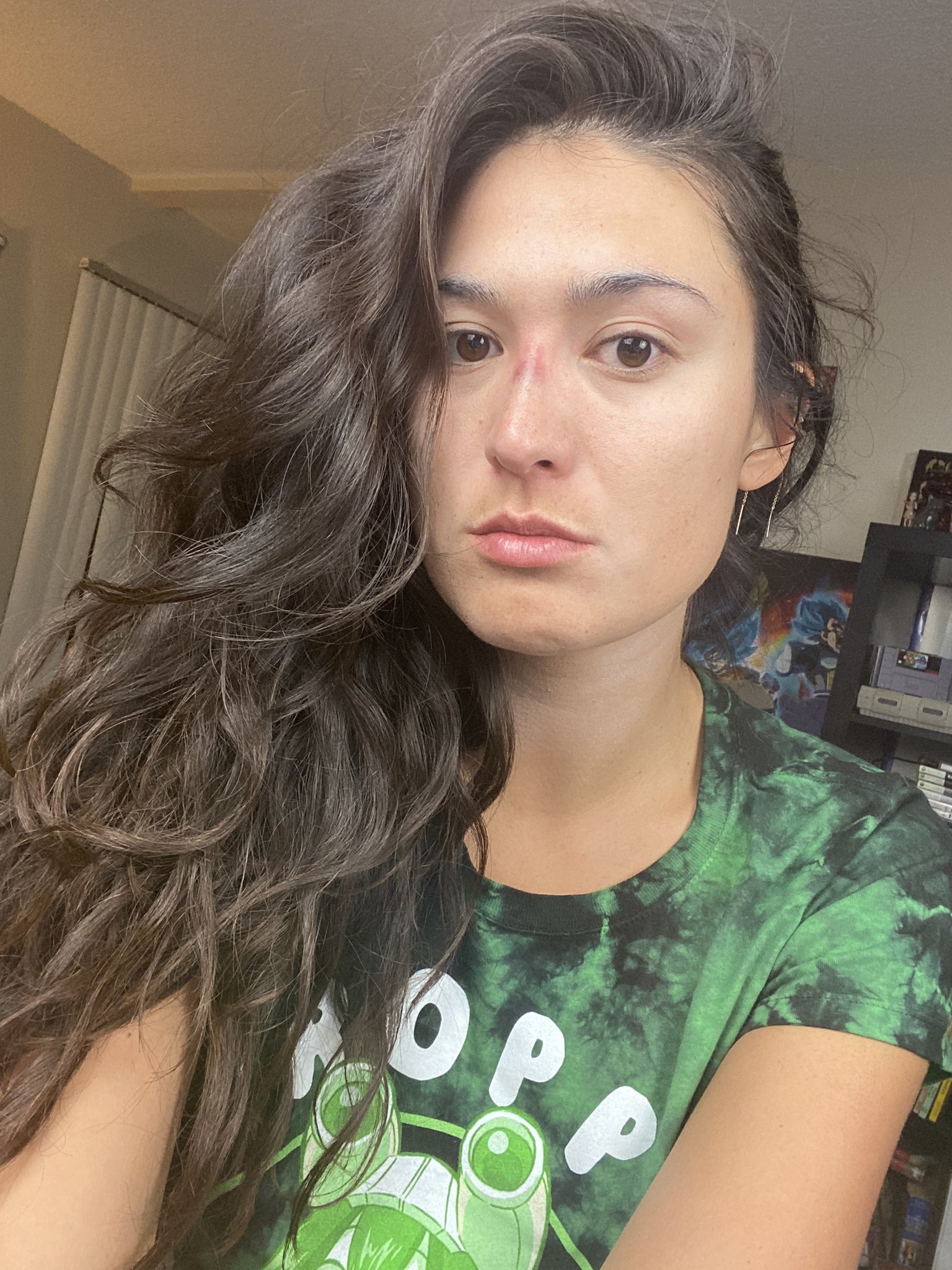 Bruised nose on sale