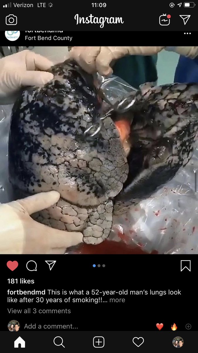 mariocast94's tweet photo. Keep smoking those money making cancer sticks!! This is what 30 years of smoking lungs look like 😷 #MDFacts https://t.co/eR8jXfJsUU