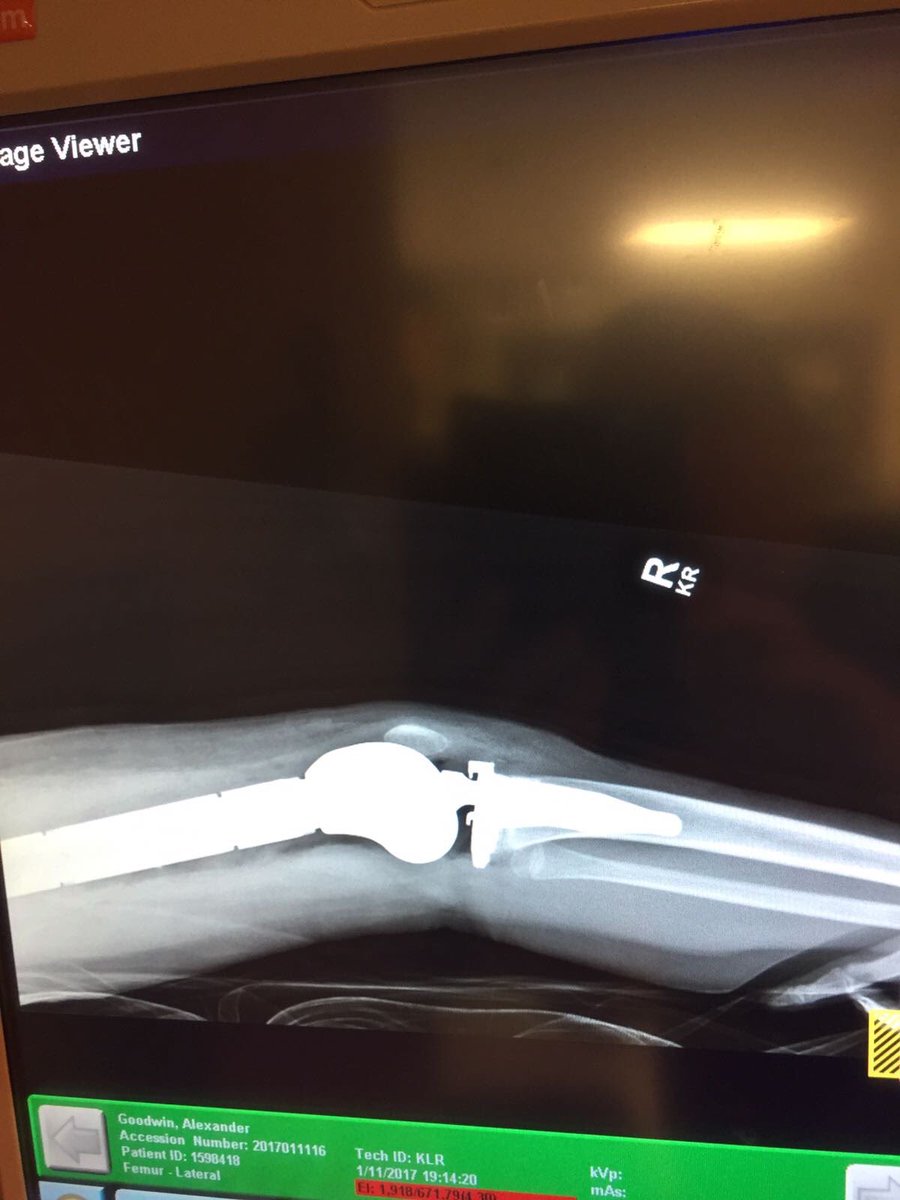 alexs_journey's tweet image. 3 years ago today he was recovering at @KUHospital after his life-saving cancer surgery. Thank you to Dr. Rosenthal, Dr. Wetzel and the amazing, committed team that is the Kansas University Health System! #Kansas @KUHospitalNews #AlexandersJourney #ChildhoodCancer 🇺🇸🇬🇧