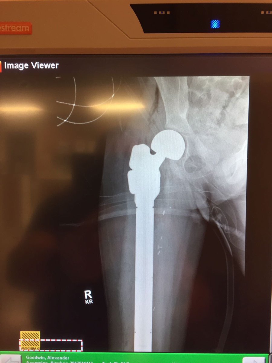 alexs_journey's tweet image. 3 years ago today he was recovering at @KUHospital after his life-saving cancer surgery. Thank you to Dr. Rosenthal, Dr. Wetzel and the amazing, committed team that is the Kansas University Health System! #Kansas @KUHospitalNews #AlexandersJourney #ChildhoodCancer 🇺🇸🇬🇧