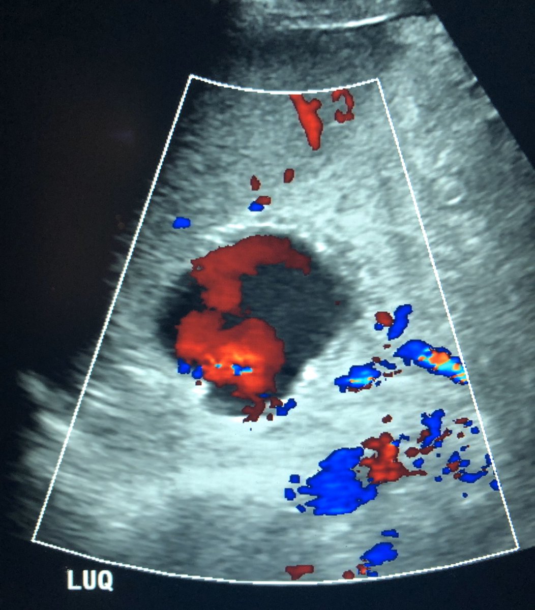 pparmetIR's tweet photo. Ruptured splenic artery aneurysm in a 23 yo pregnant patient at 19 weeks.  Emergent embolization (sandwich technique) by #IRad to save both mother and baby #withoutascalpel; collateral splenic perfusion maintained.  @SIRspecialists @JVIRmedia @GESTSymposium @SIR_ECS @SIRRFS https://t.co/cptKL0wgbC