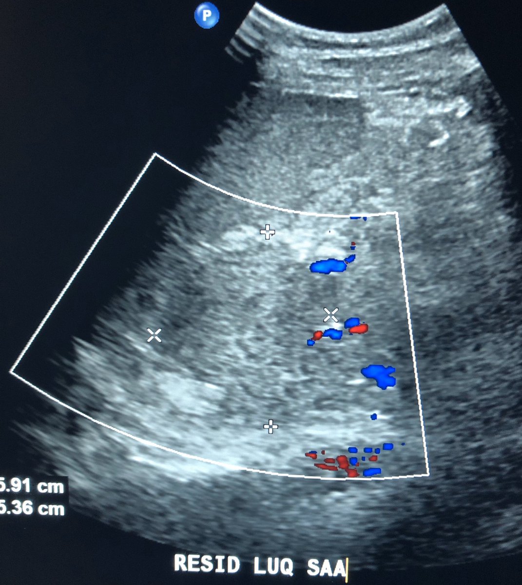 pparmetIR's tweet photo. Ruptured splenic artery aneurysm in a 23 yo pregnant patient at 19 weeks.  Emergent embolization (sandwich technique) by #IRad to save both mother and baby #withoutascalpel; collateral splenic perfusion maintained.  @SIRspecialists @JVIRmedia @GESTSymposium @SIR_ECS @SIRRFS https://t.co/cptKL0wgbC