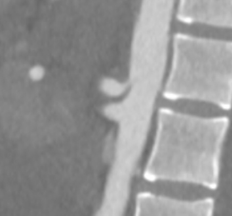pparmetIR's tweet photo. Added challenge of MALS anatomy https://t.co/eJtelyPWqV