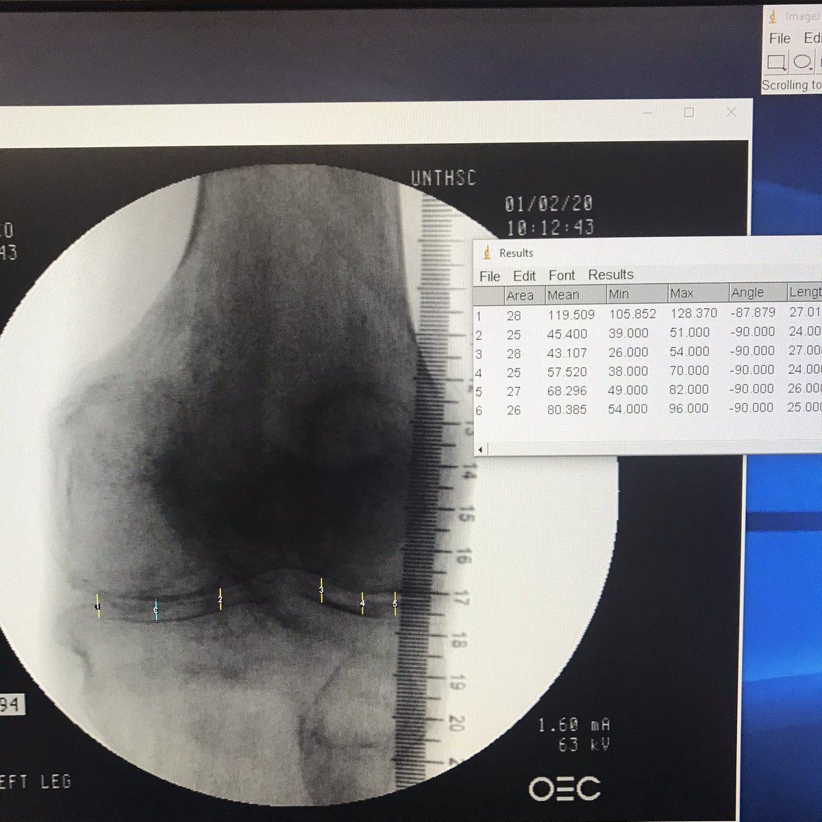 FincoGraci's tweet photo. ImageJ is my new favorite software. @MenegazLab has opened my eyes to a whole new world of measuring musculoskeletal properties like pennation angles, joint spaces, and bone widths! @GSBS_UNTHSC @UNTHSC @HMPLab #loading #xray #bones #biomechanics https://t.co/udWiZ0bBhU