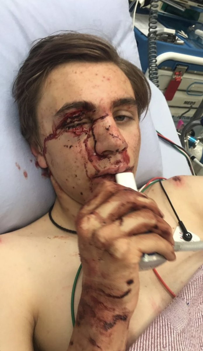 Boys who take a chainring to the eyeball 😍😍😍>>>>>>>