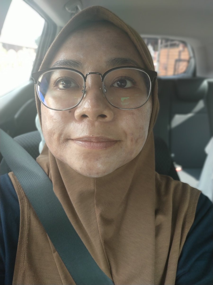 afifahpamasis's tweet photo. "yang ni treatment yg kulit mengelupas macam ular salin kulit tu taw"

currently kulit rasa tight and nampak glossy. white cast suncsreen pon nampak obvious sangat. no contact with water for 12 hours. 

#TCApeel
#HannanMedispa
#oversharingday1 https://t.co/EiOTv8t1nA