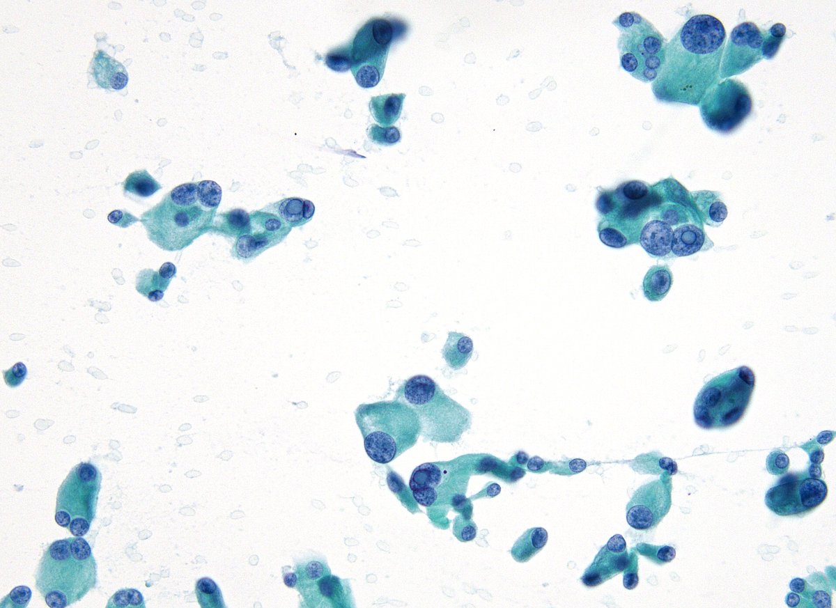 sza_jhcyto's tweet photo. "And Yes", Pancreatic Neuroendocrine Tumors (PanNETs) can have rare intranuclear inclusions/INCIs (at 3, 6 and 9 o'clock). With these INCIs, the differential would also include a Solid Pseudopapillary Neoplasm. I have personally seen rare INCIs in p-diff Acinar Cell CAs as well. https://t.co/WTgiZCl255