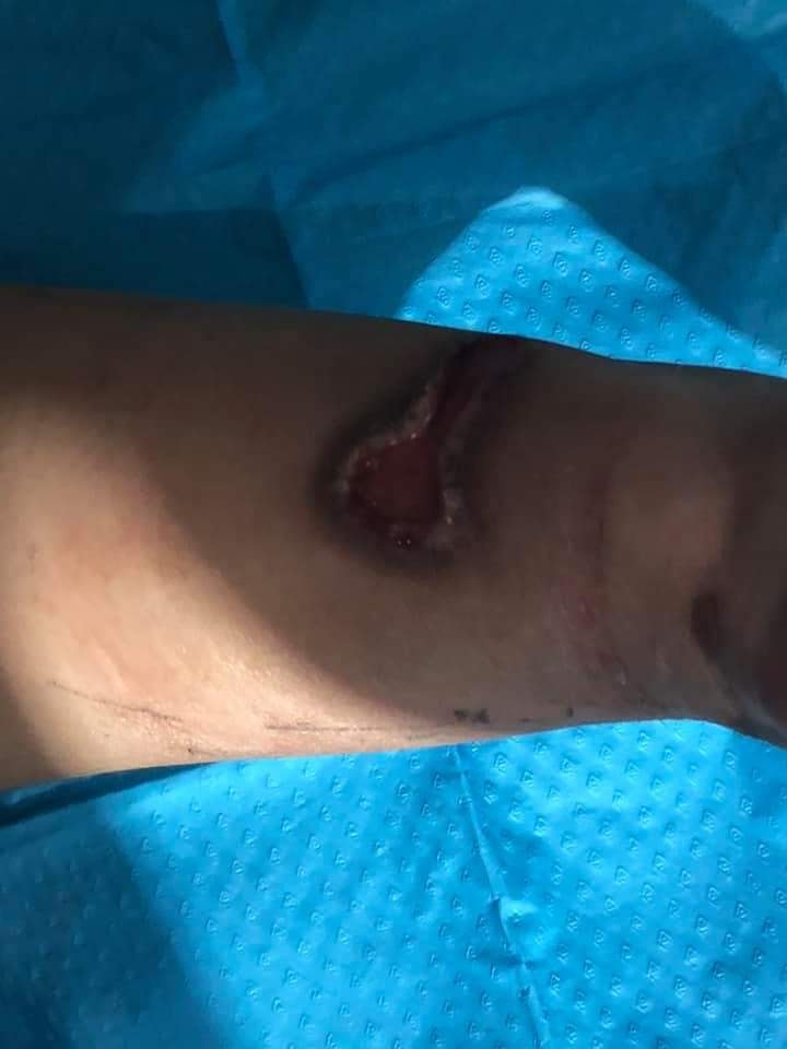 HkMarch's tweet photo. This teenager was hit by a tear gas canister on Oct 20. The wound persists for more than two months. He stayed strong while the wound was cleaned today — only shaking painfully, without making a noise. What a tough boy. https://t.co/YVnBaWf8J1 https://t.co/62eMqsY8wq