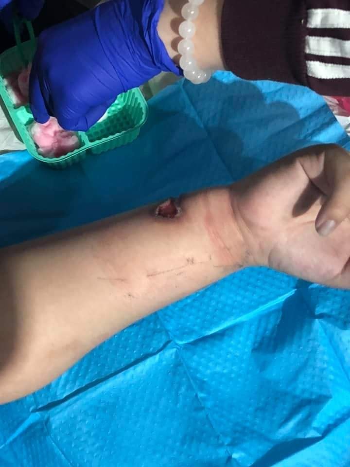 HkMarch's tweet photo. This teenager was hit by a tear gas canister on Oct 20. The wound persists for more than two months. He stayed strong while the wound was cleaned today — only shaking painfully, without making a noise. What a tough boy. https://t.co/YVnBaWf8J1 https://t.co/62eMqsY8wq