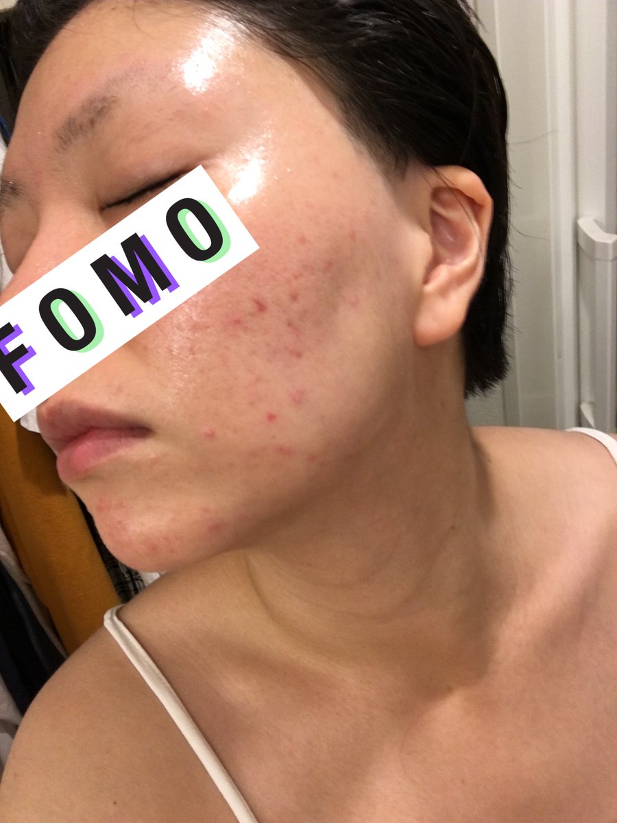 とにかく明るいうに助 すっぴん 汚肌注意です ニキビが治らなくて皮膚科に行ってるので経過をメモ程度に 右 19年11月 左 年1月 今日 顔の赤みが消えた ニキビができなくなった 今あるのはニキビ跡 化粧がしやすくなったし とにかく明るいうに助 すっぴん 汚肌注意です ニキビが治らなくて皮膚科に行ってるので経過をメモ程度に 右 19年11月 左 年1月 今日 顔の赤みが消えた ニキビができなくなった 今あるのはニキビ跡 化粧がしやすくなったし