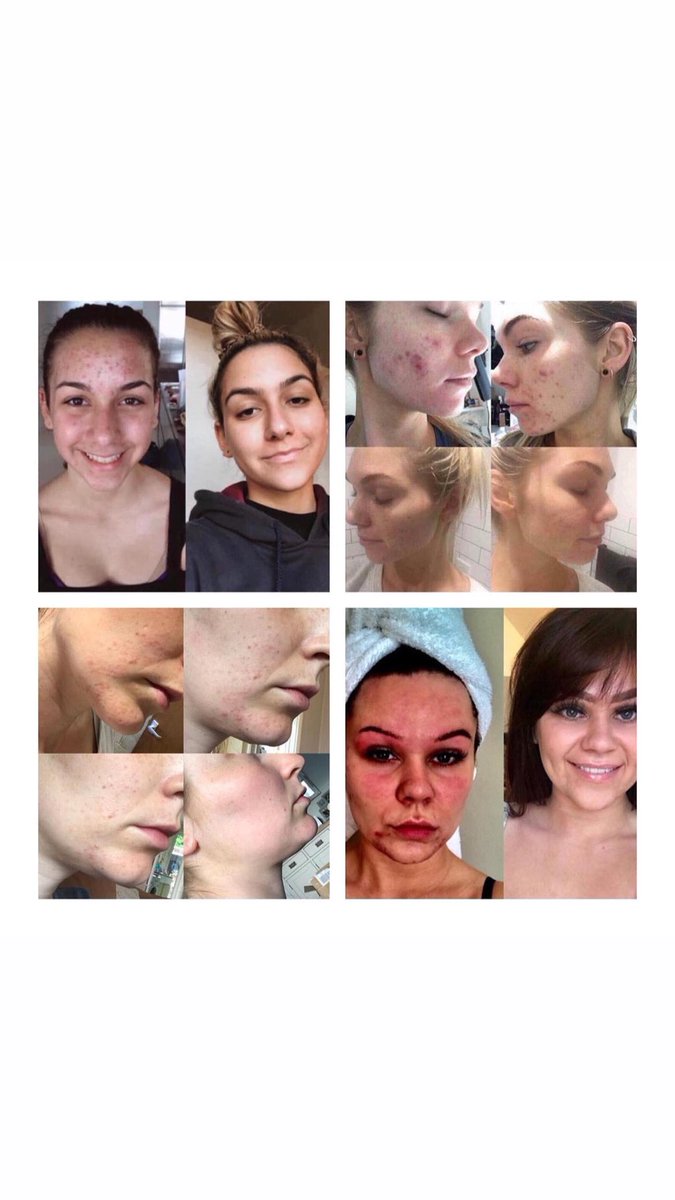 abzfielding's tweet photo. LET IT GLOW, LET IT GLOW😍

83p a day and our girls have that #ultimate #glowy #skin going on🤩#Berry #capsules will always be my #fave beauty plan🍇 #girls these #babies are #amazing just look at those #results 🙊 you no what to do!⬇️📨 https://t.co/JwKwsJeHCA