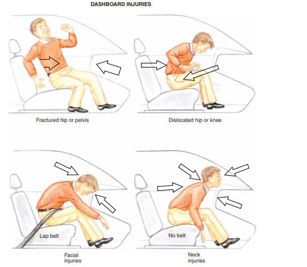 à¦Ÿ à¦‡à¦Ÿ à¦° John Furst An Overview Of Dashboard Injuries In Motor Vehicle Collisions Dashboard Injuries Occur Most Often To An Unrestrained Passenger The Dashboard Has The Capability Of Producing A Variety Of Injuries