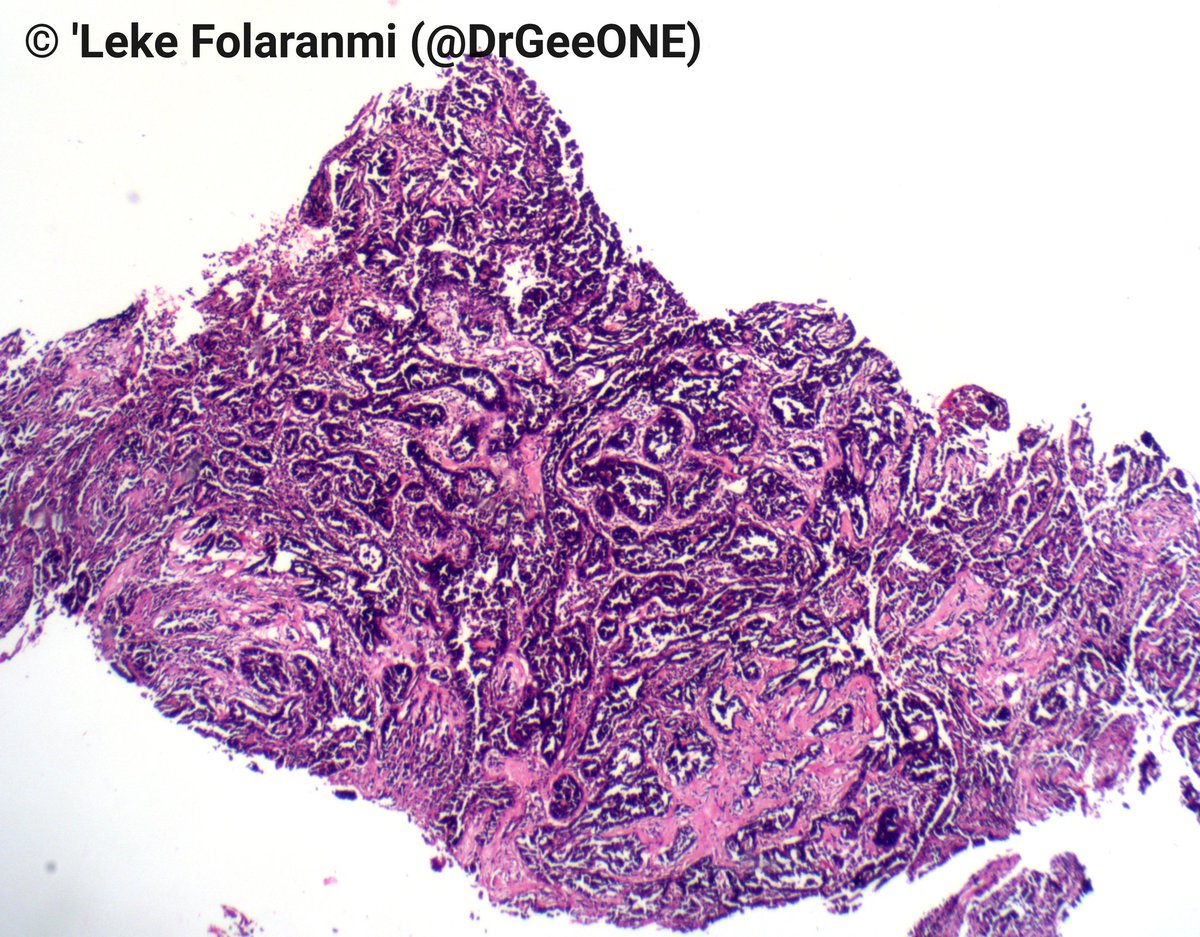 DrGeeONE's tweet photo. 1/2
Sharing this case from a colleague who is not active here:
An elderly male with cough.
CT showed multiloculated pleural fluid, VAT showed multiple nodular pleural masses.
IHC done at another center:
Calretinin, CK7/20, TTF-1 All negative.
Any thoughts?
#Pulmpath #Pathology https://t.co/q571nDoZ9v