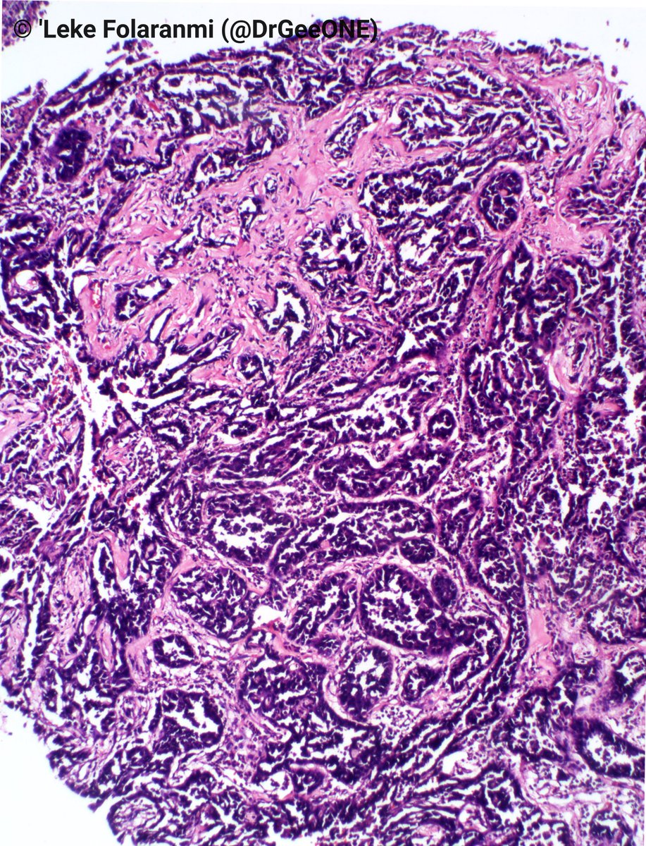 DrGeeONE's tweet photo. 1/2
Sharing this case from a colleague who is not active here:
An elderly male with cough.
CT showed multiloculated pleural fluid, VAT showed multiple nodular pleural masses.
IHC done at another center:
Calretinin, CK7/20, TTF-1 All negative.
Any thoughts?
#Pulmpath #Pathology https://t.co/q571nDoZ9v